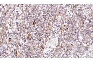 ABIN6273202 at 1/100 staining Human lymph cancer tissue by IHC-P. (BBS4 anticorps  (Internal Region))