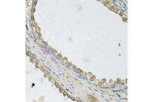 Immunohistochemistry of paraffin-embedded human prostate using MTERFD1 antibody at dilution of 1:100 (x40 lens). (MTERFD1 anticorps)