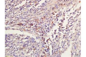 paraformaldehyde-fixed, paraffin embedded human laryngocarcinoma tissue; Antigen retrieval with 0.