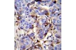 Immunohistochemistry analysis in formalin fixed and paraffin embedded human breast carcinoma reacted PIP / GCDFP15 Antibody (C-term) followed by peroxidase conjugation of the secondary antibody and DAB staining. (PIP anticorps  (C-Term))