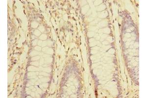 Immunohistochemistry of paraffin-embedded human colon cancer using ABIN7170360 at dilution of 1:100 (SNX16 anticorps  (AA 1-342))