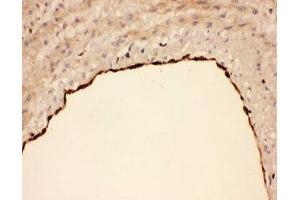 IHC-P: COX1 antibody testing of human lung cancer tissue