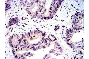 Immunohistochemical analysis of paraffin-embedded colon cancer tissues using BIRC5 mouse mAb with DAB staining.