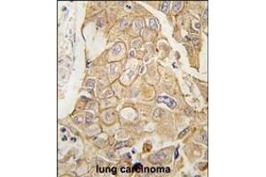 Formalin-fixed and paraffin-embedded human lung carcinoma tissue reacted with ADCY2 antibody (C-term) (ABIN389223 and ABIN2839376) , which was peroxidase-conjugated to the secondary antibody, followed by DAB staining. (ADCY2 anticorps  (C-Term))