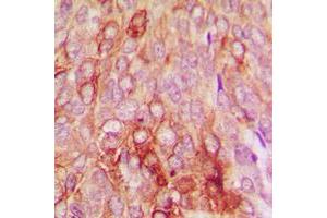 Immunohistochemical analysis of Serpin B5 staining in human breast cancer formalin fixed paraffin embedded tissue section.