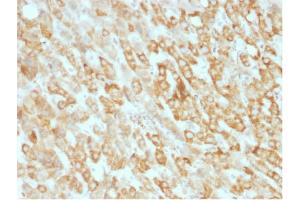 Formalin-fixed, paraffin-embedded human Hepatic Carcinoma stained with Prohibitin Mouse Monoclonal Antibody (SPM311).