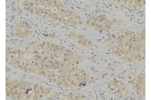 ABIN6272936 at 1/100 staining Human breast cancer tissue by IHC-P. (AP3B1 anticorps  (C-Term))