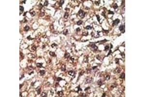 IHC analysis of FFPE human hepatocarcinoma tissue stained with the PINK1 antibody (PINK1 anticorps  (AA 118-147))