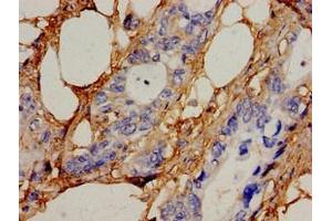 Immunohistochemistry analysis of human pancreatic cancer using ABIN7169051 at dilution of 1:100 (ICK anticorps  (AA 150-275))
