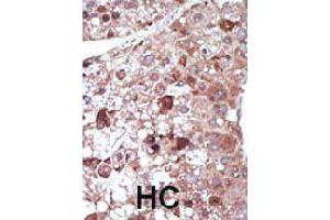 Formalin-fixed and paraffin-embedded human hepatocellular carcinoma tissue reacted with PCK1 polyclonal antibody  , which was peroxidase-conjugated to the secondary antibody, followed by DAB staining. (PCK1 anticorps  (N-Term))