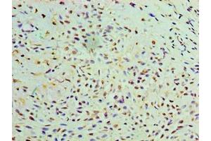 Immunohistochemistry of paraffin-embedded human breast cancer using ABIN7174611 at dilution of 1:100 (GALE anticorps  (AA 1-348))