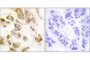 Immunohistochemistry analysis of paraffin-embedded human breast carcinoma, using CaMK1-alpha (Phospho-Thr177) Antibody. (CAMK1 anticorps  (pThr177))