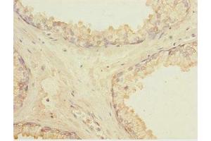 Immunohistochemistry of paraffin-embedded human prostate cancer using ABIN7158367 at dilution of 1:100