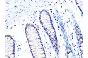 Immunohistochemistry of paraffin-embedded human colon using MT Rabbit mAb (ABIN1679683, ABIN7101713, ABIN7101714 and ABIN7101715) at dilution of 1:100 (40x lens). (MTA2 anticorps)