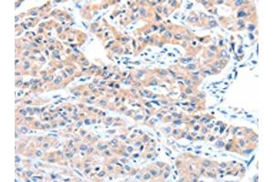 The image on the left is immunohistochemistry of paraffin-embedded Human lung cancer tissue using ABIN7128234(ADAM32 Antibody) at dilution 1/15, on the right is treated with fusion protein. (ADAM32 anticorps)