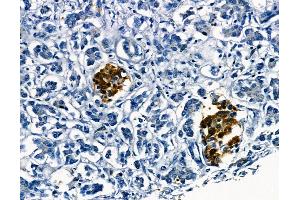 ABIN6265446 and ABIN6278639 at 1/100 staining human gastric cancer by IHC-P. (TAL1 anticorps  (C-Term))