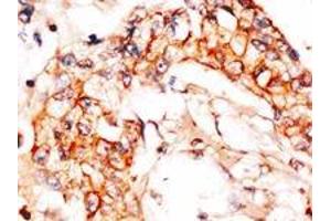 Formalin-fixed and paraffin-embedded human breast carcinoma reacted with anti-APPBP1 (C-term), which was peroxidase-conjugated to the secondary antibody, followed by DAB staining. (NAE1 anticorps  (C-Term))