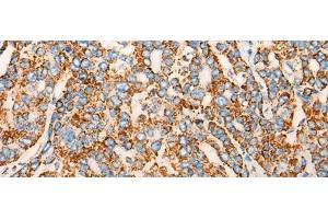 Immunohistochemistry of paraffin-embedded Human liver cancer tissue using CHCHD3 Polyclonal Antibody at dilution of 1:45(x200) (CHCHD3 anticorps)