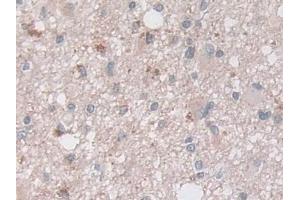 Detection of ASAH1 in Human Glioma Tissue using Polyclonal Antibody to N-Acylsphingosine Amidohydrolase 1 (ASAH1)