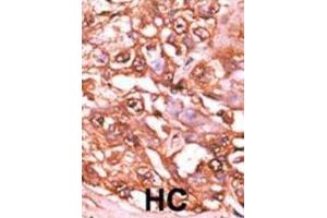 Immunohistochemistry (IHC) image for anti-Signal Transducer and Activator of Transcription 5A (STAT5A) (pSer726) antibody (ABIN5021402)