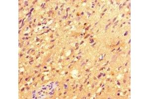 Immunohistochemistry of paraffin-embedded human glioma using ABIN7147801 at dilution of 1:100 (IRG1 anticorps  (AA 57-257))