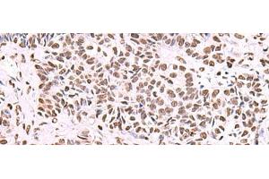 Immunohistochemistry of paraffin-embedded Human ovarian cancer tissue using NASP Polyclonal Antibody at dilution of 1:55(x200)
