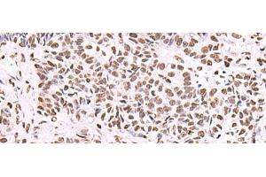 Immunohistochemistry of paraffin-embedded Human ovarian cancer tissue using NASP Polyclonal Antibody at dilution of 1:55(x200) (NASP anticorps)