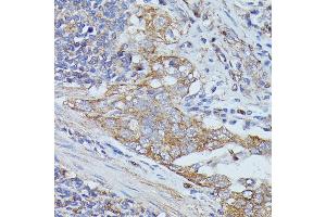 Immunohistochemistry of paraffin-embedded human lung cancer using Cortactin antibody  at dilution of 1:100 (40x lens).