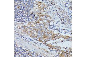 Immunohistochemistry of paraffin-embedded human lung cancer using Cortactin antibody  at dilution of 1:100 (40x lens). (Cortactin anticorps  (AA 1-200))