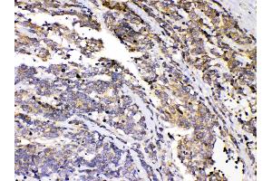 PRKAR1A was detected in paraffin-embedded sections of human lung cancer tissues using rabbit anti- PRKAR1A Antigen Affinity purified polyclonal antibody (Catalog # ) at 1 µg/mL.