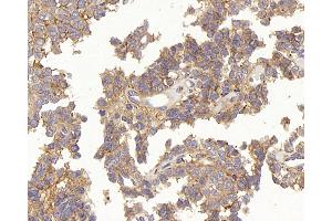 Immunohistochemistry analysis of paraffin-embedded human stomach cancer using TEK Polyclonal Antibody at dilution of 1:200. (TEK anticorps)