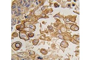 IHC analysis of FFPE human lung carcinoma tissue stained with TLR6 antibody