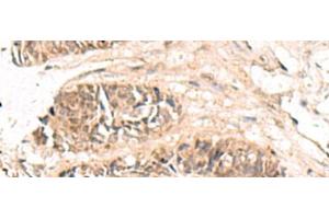 Immunohistochemistry of paraffin-embedded Human colorectal cancer tissue using ABCB4 Polyclonal Antibody at dilution of 1:70(x200) (ABCB4 anticorps)