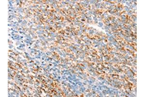 The image on the left is immunohistochemistry of paraffin-embedded Human ovarian cancer tissue using ABIN7192795(THY1 Antibody) at dilution 1/25, on the right is treated with synthetic peptide. (CD90 anticorps)