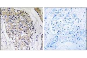Immunohistochemistry analysis of paraffin-embedded human breast carcinoma tissue, using NDUFS6 Antibody. (NDUFS6 anticorps  (AA 75-124))