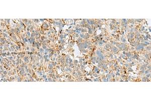 Immunohistochemistry of paraffin-embedded Human cervical cancer tissue using VDAC3 Polyclonal Antibody at dilution of 1:30(x200) (VDAC3 anticorps)