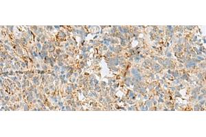 Immunohistochemistry of paraffin-embedded Human cervical cancer tissue using VDAC3 Polyclonal Antibody at dilution of 1:30(x200)