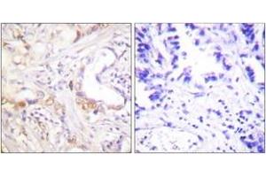 Immunohistochemistry analysis of paraffin-embedded human lung carcinoma tissue, using PIAS3 Antibody. (PIAS3 anticorps  (AA 10-59))