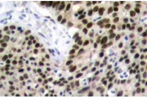 Immunohistochemistry (IHC) analyzes of HSF1 antibody in paraffin-embedded human breast carcinoma tissue. (HSF1 anticorps)