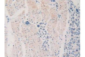 IHC-P analysis of Human Stomach Cancer Tissue, with DAB staining. (PDHX anticorps  (AA 220-468))