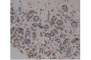 Detection of NOG in Human Breast Cancer Tissue using Monoclonal Antibody to Noggin (NOG) (NOG anticorps  (AA 28-232))