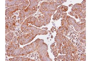 IHC-P Image Immunohistochemical analysis of paraffin-embedded human lung SCC, using IDH3A, antibody at 1:100 dilution.