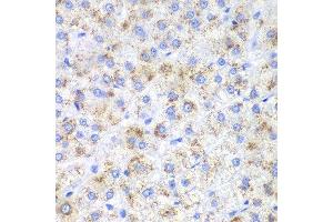 Immunohistochemistry of paraffin-embedded human liver cancer using HAO1 antibody. (HAO1 anticorps  (AA 1-370))