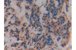 Detection of VAV3 in Human Breast cancer Tissue using Polyclonal Antibody to Vav 3 Oncogene (VAV3) (VAV3 anticorps  (AA 183-380))