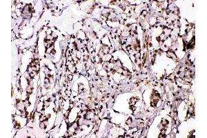 Islet 1 was detected in paraffin-embedded sections of human mammary cancer tissues using rabbit anti- Islet 1 Antigen Affinity purified polyclonal antibody (Catalog # ) at 1 µg/mL. (ISL1 anticorps  (Middle Region))