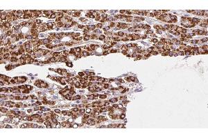 ABIN6272458 at 1/100 staining Human liver cancer tissue by IHC-P.
