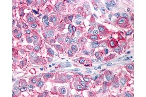 Anti-NPY1R antibody IHC of human Skin, Melanoma. (NPY1R anticorps  (Cytoplasmic Domain))