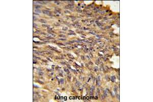 Formalin-fixed and paraffin-embedded human lung carcinoma reacted with HDLBP Antibody , which was peroxidase-conjugated to the secondary antibody, followed by DAB staining. (HDLBP anticorps  (AA 764-791))