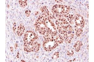 IHC-P Image Immunohistochemical analysis of paraffin-embedded NCI-N87 xenograft, using ALOXE3, antibody at 1:500 dilution. (ALOXE3 anticorps)