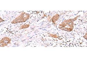 Immunohistochemistry of paraffin-embedded Human esophagus cancer tissue using SASH1 Polyclonal Antibody at dilution of 1:30(x200) (SASH1 anticorps)